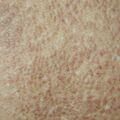 lichenamyloidosis020307-2.jpg