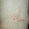 lichenplanus020309-1.jpg