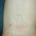 lichenplanus020309-2.jpg