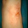 lichensimplexchronicus9-318.jpg