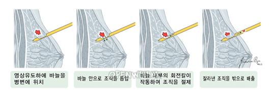mammotome_0335.png