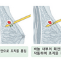 mammotome_0335.png