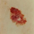 melanoma.jpg