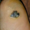 melanoma030816.jpg