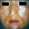 melasma.jpg