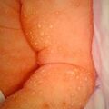 miliaria_pustular5-69.jpg