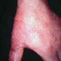 misuse_acd_ketoprofen2000-61.jpg