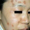 misuse_acetate020219.jpg