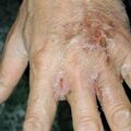 misuse_acetate020316.jpg