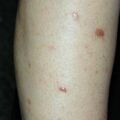 misuse_acetate020615.jpg