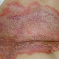 misuse_acetate020817-1.jpg