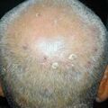 misuse_acetate020817-2.jpg