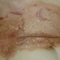 misuse_acetate020912-2.jpg