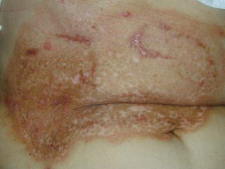 misuse_acetate020912-2.jpg