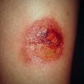 misuse_acetate9-983.jpg