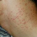 misuse_acne010726.jpg