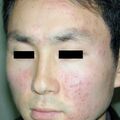 misuse_acupuncture020211-1.jpg