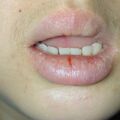 misuse_acyclovir010302.jpg