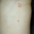 misuse_acyclovir010711-1.jpg