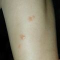 misuse_acyclovir010711-2.jpg