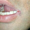 misuse_acyclovir010718.jpg