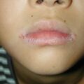 misuse_acyclovir010828.jpg
