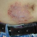 misuse_acyclovir011110.jpg