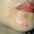 misuse_acyclovir020214.jpg