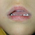 misuse_acyclovir020218.jpg