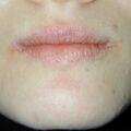misuse_acyclovir020308.jpg