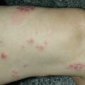 misuse_acyclovir020409.jpg