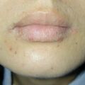 misuse_acyclovir020416.jpg