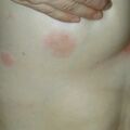 misuse_acyclovir020701-1.jpg