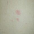 misuse_acyclovir020701-2.jpg