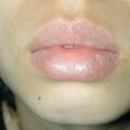 misuse_acyclovir020808.jpg
