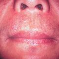 misuse_acyclovir2000-206.jpg