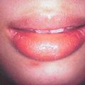 misuse_acyclovir2000-225.jpg