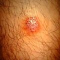 misuse_acyclovir9-517.jpg