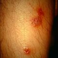 misuse_acyclovir9-518.jpg