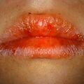 misuse_acyclovir9-540.jpg