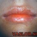 misuse_acyclovir9-758.jpg