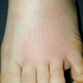 misuse_antifungal010512.jpg