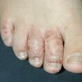 misuse_antifungal010808.jpg