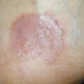 misuse_antifungal010813.jpg