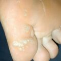 misuse_antifungal010907.jpg