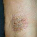 misuse_antifungal010926.jpg