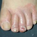 misuse_antifungal010928-1.jpg