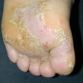 misuse_antifungal010928-2.jpg