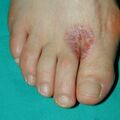 misuse_antifungal020719-1.jpg