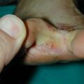 misuse_antifungal020719-2.jpg